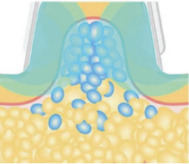 脂肪冷却の仕組み：脂肪吸引と冷却