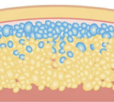 脂肪冷却の仕組み：脂肪細胞の結晶化