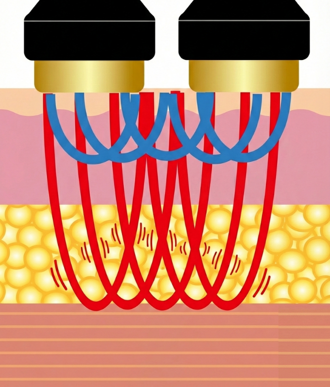 Wキャビテーション＆W超音波